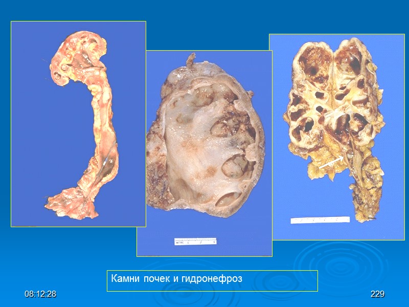 08:12:02 Камни почек и гидронефроз 229